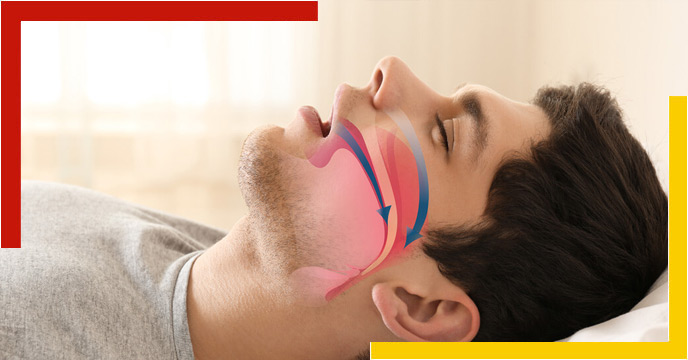 obstructive sleep apnea