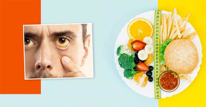Symptoms of Jaundice - Yellowing of Skin and Eyes