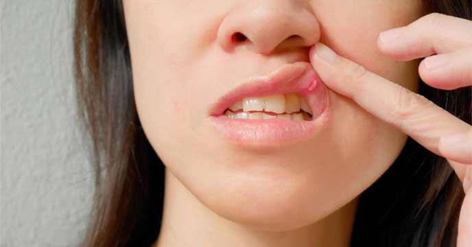 Relieve Mouth Wounds by Drinking Milk Every Night: Proven Remedy