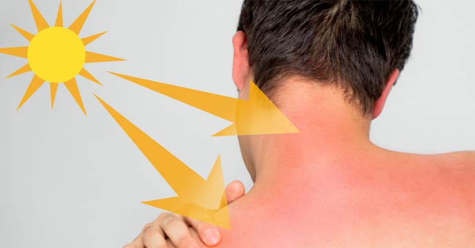 Sunburned Neck