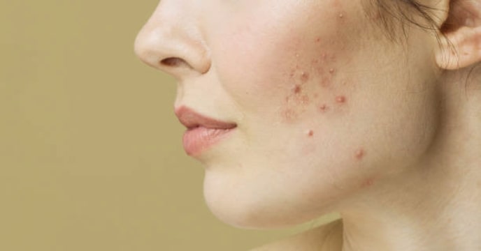 Pimple Remedies