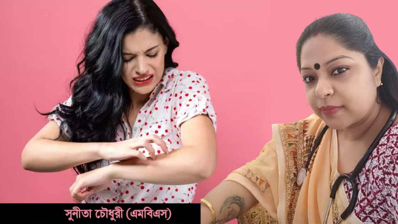 Five Homeopathy Medicines to Keep Close to Treat Heat Rash or Itching