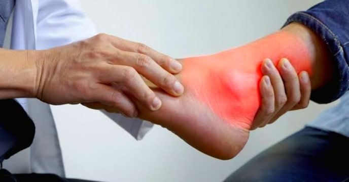 Uric Acid