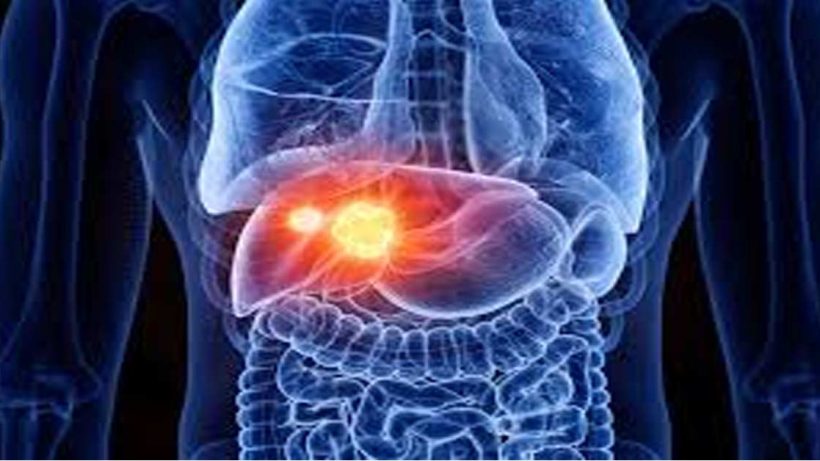 Fatty liver causes cancer